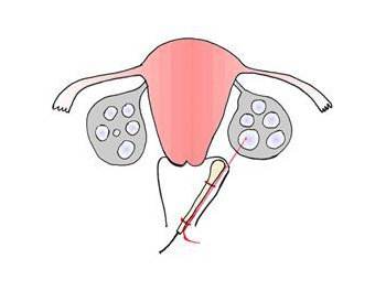 什么是卵泡穿刺？用途是什么？