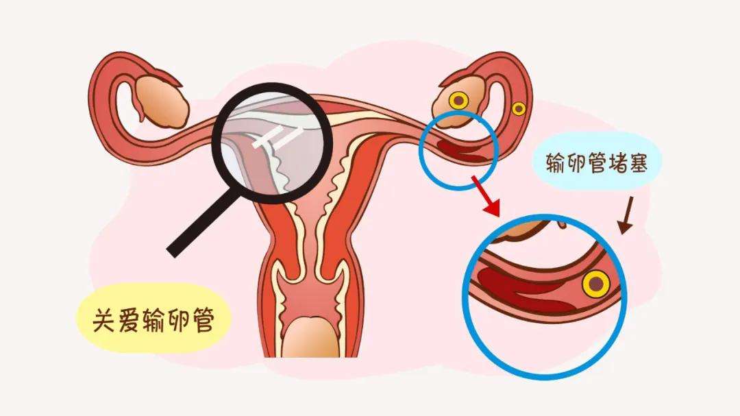 输卵管不孕怎么办？